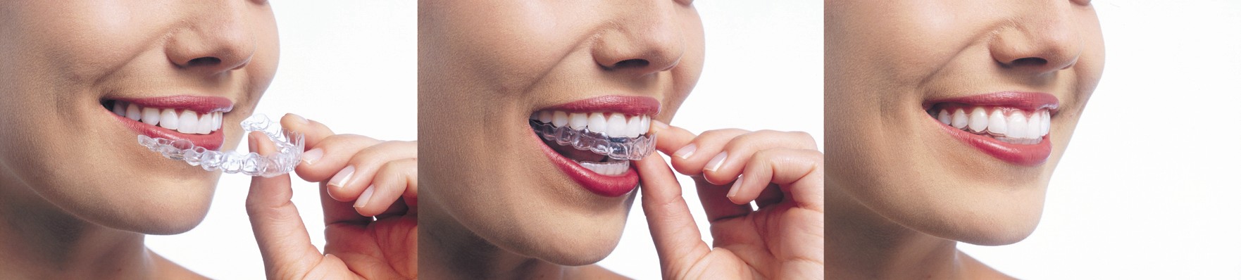 Invisalign Clear Braces