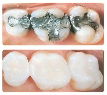 White Composite Fillings - before and after