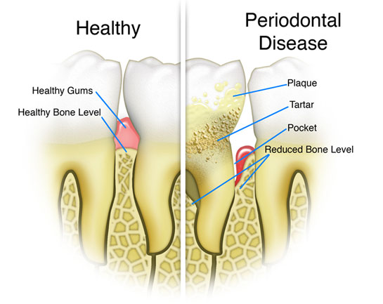 Healthy Gum and Periodontal Disease comparison
