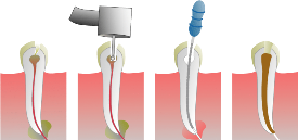 Root Canal Treatment