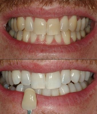 Straight teeth with no metal by Dean Cosmetic Dentistry